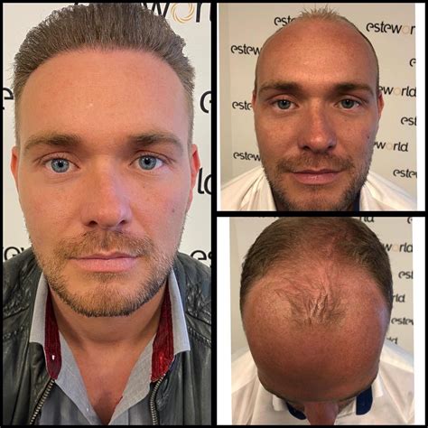 De Beste Haartransplantatie Behandeling Voor Jou
