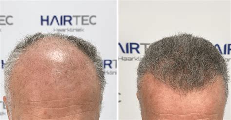 Herstel Na Haartransplantatie: Wat Te Verwachten